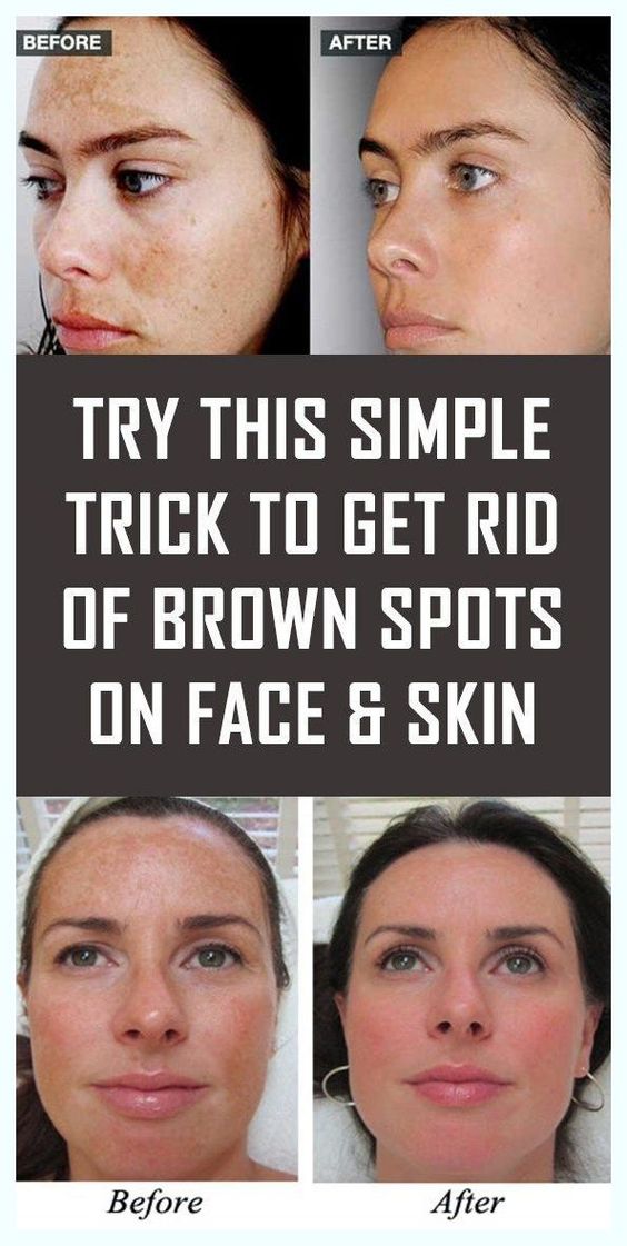 simple-trick-to-remove-brown-spots-from-your-skin