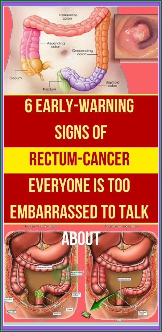 6 Early Warning Symptoms Of Anal Cancer And Its Risk Factors