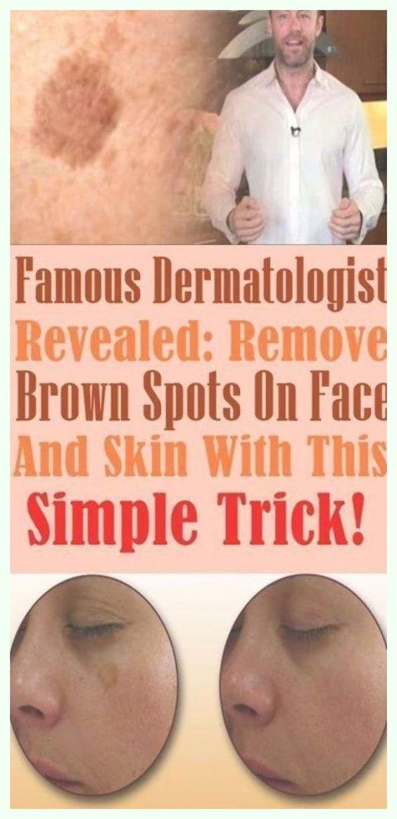 simple-trick-to-remove-brown-spots-from-your-skin